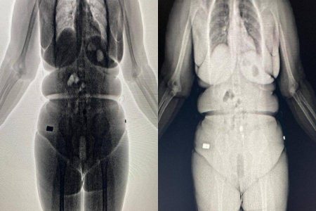 Body Scan flagra mulheres com drogas no presídio de Barreiras