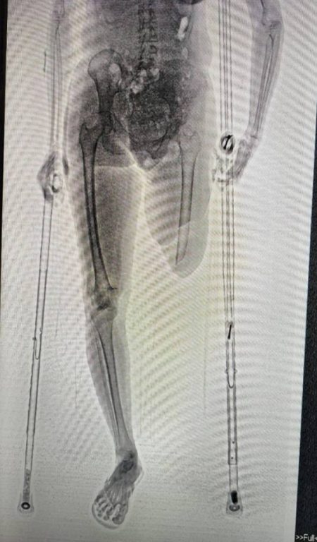 Mãe de detento tenta entrar em presídio com massa epóxi dentro de muleta