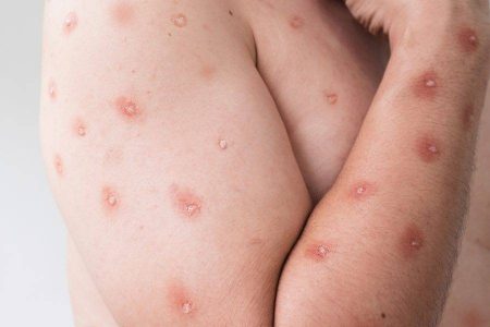 Bahia monitora novo caso suspeito de Mpox; paciente está isolado