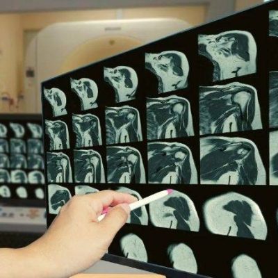 ressonancia ombro manguito