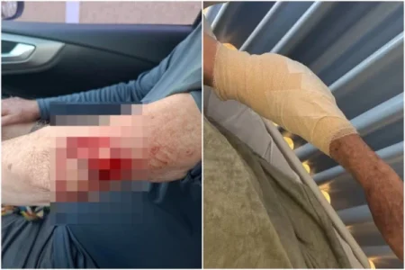 Idoso atacado por pitbull em Stella Maris precisará de enxerto de pele após cirurgia
